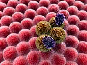 Лечение ретикулосаркомы