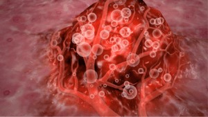 SIRT-терапия в Израиле