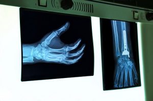 Лечение болезни Олье в Израиле