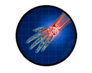 Лечение болезни Олье в Израиле