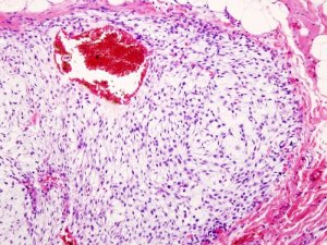 хондросаркома