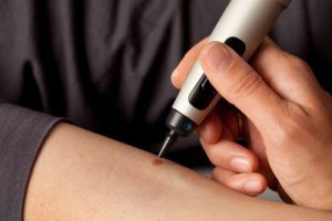 метод криодеструкции