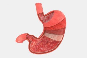 Виды операций при раке желудка в Израиле